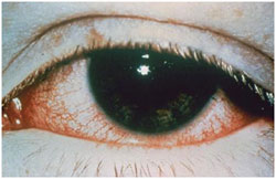 Eye damage from chemical exposure