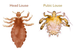 Head vs. public lice