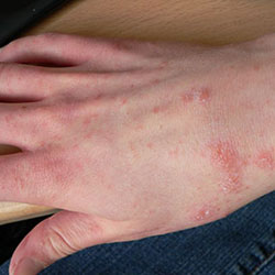 Scabies symptoms