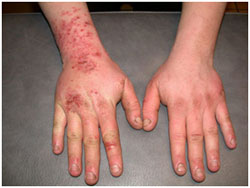 Skin reaction to chemical exposure