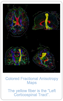 Colored Fractional Anisotropy Maps, and the yellow fiber is the 'Left Corticospinal Tract'
