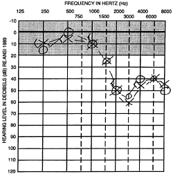 audiogram showing hearing loss between 2000 Hz and 4000 Hz